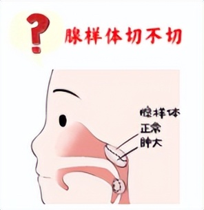 儿童分泌性中耳炎耳闷怎么缓解,儿童分泌性中耳炎怎么判断轻重