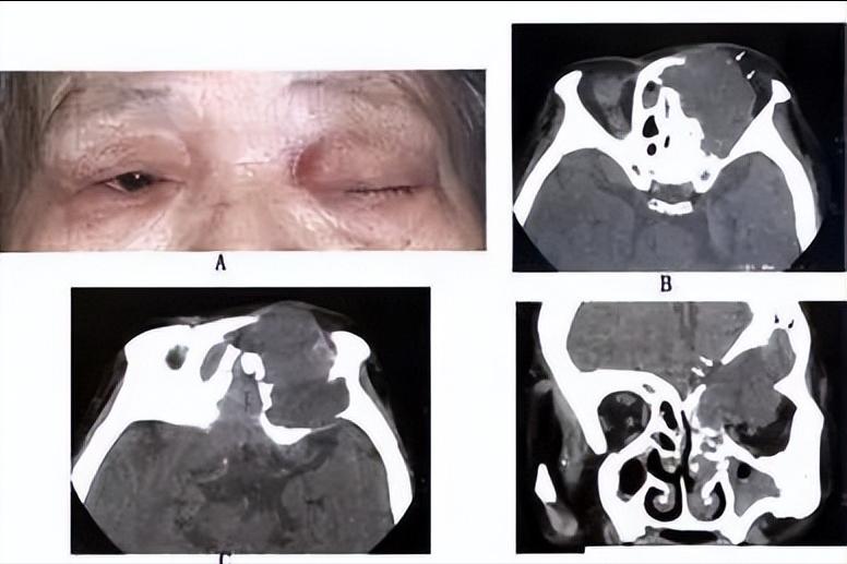 鼻窦浆液性囊肿症状,小石头学习