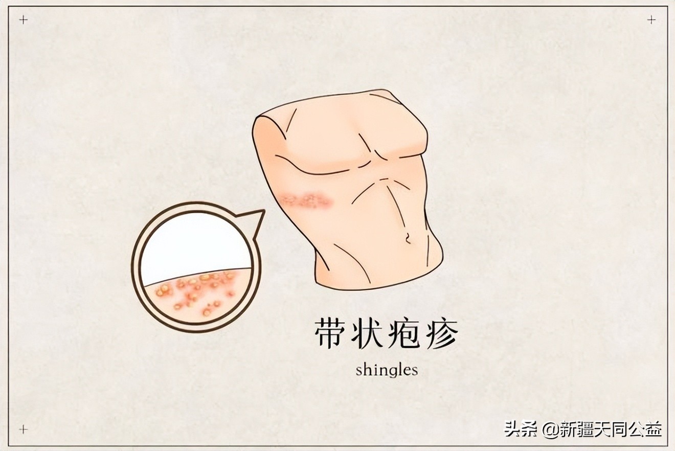 带状疱疹是不是艾滋病的初期,年轻人得了带状疱疹就是艾滋病么
