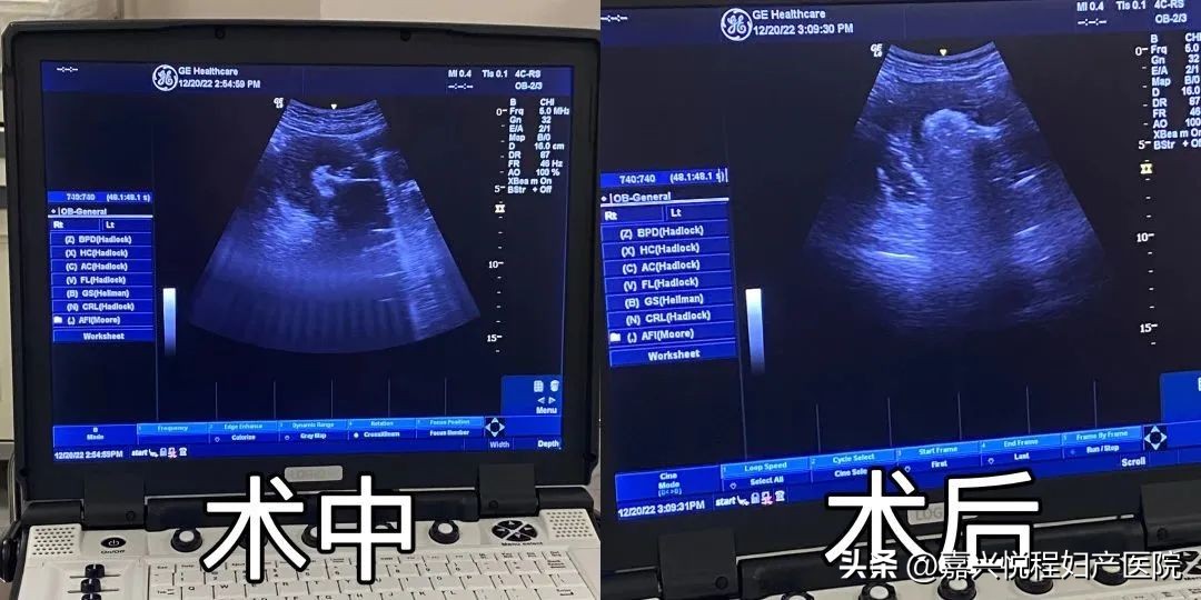 不开刀的子宫肌瘤消融术,子宫肌瘤无创超声消融术费用