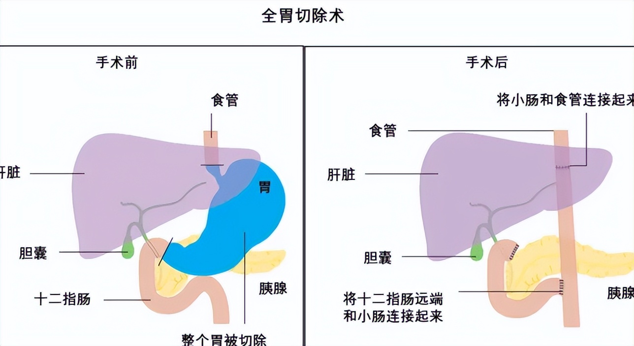 胃癌术后吃什么比较好,胃癌术后怎么饮食