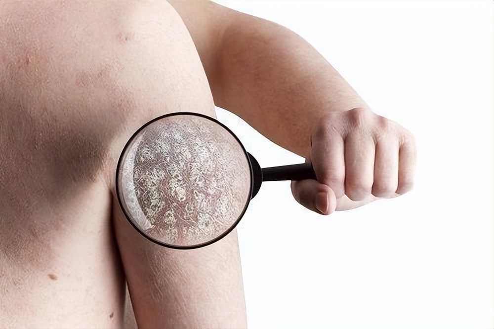 银屑病中医辨证论治根源,中药外用治银屑病研究进展