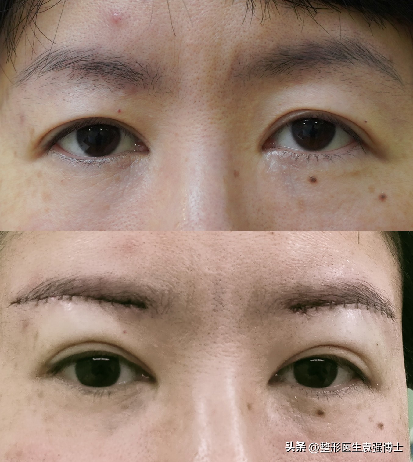 抗衰医美步骤有哪些项目,抗衰的医美项目有哪些