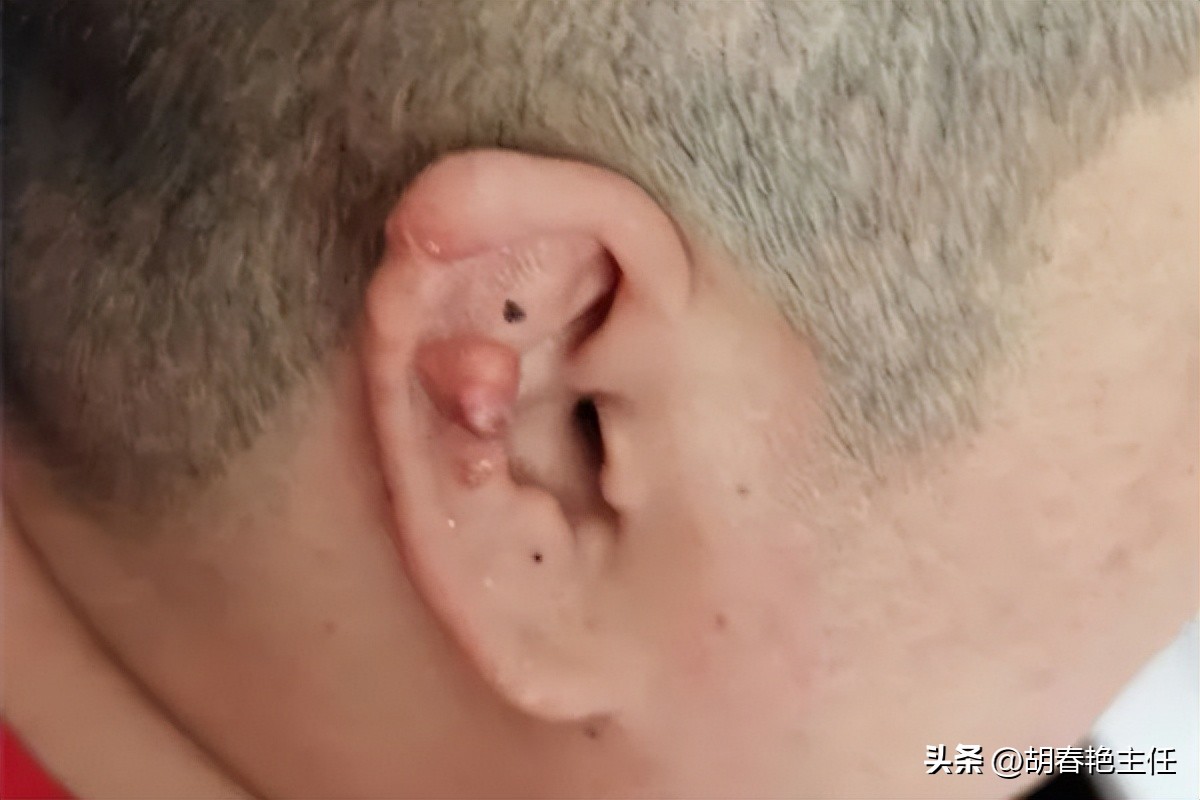 尿酸高的症状对身体有哪些危害,男人尿酸高的症状与危害