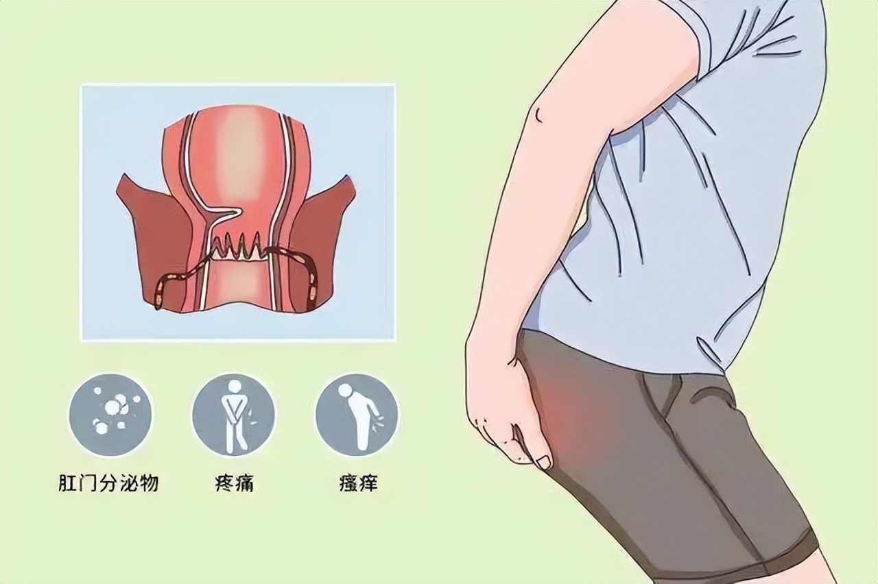 中医肛瘘的辨证论治,肛瘘中医和西医哪个好