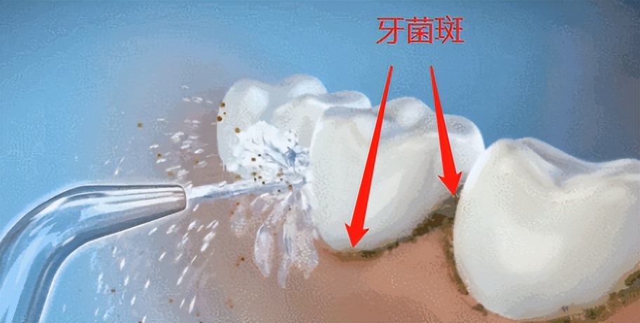 冲牙器测评视频大全,六款热门冲牙器测评