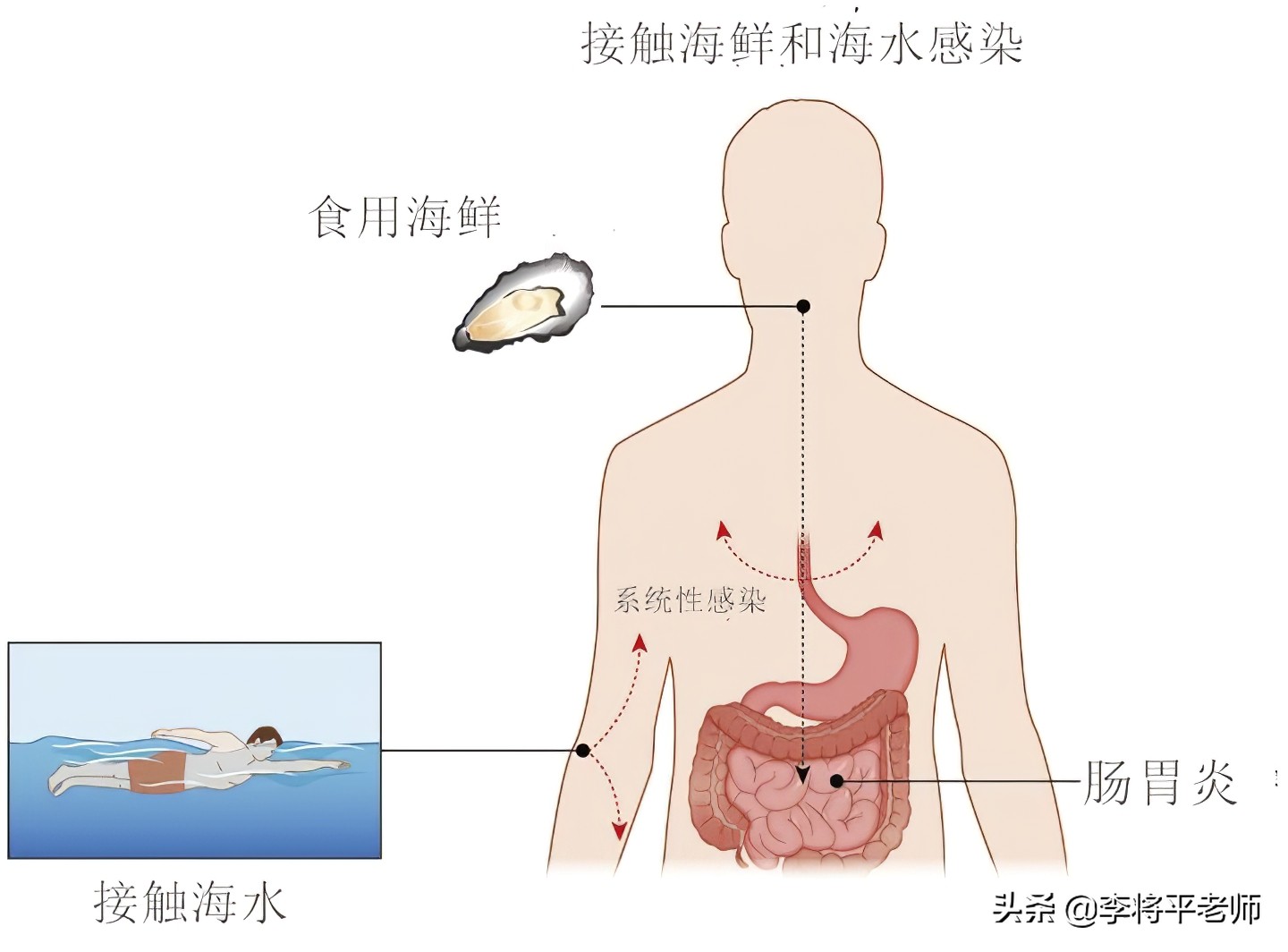 女子被河虾刺到导致截肢,被河虾扎手截肢
