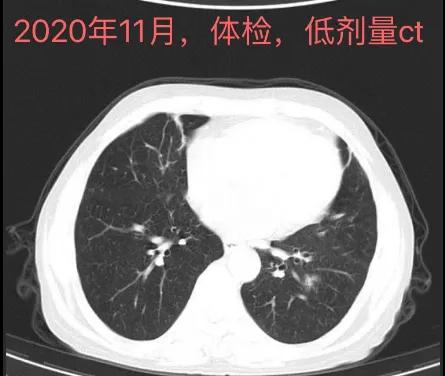磨玻璃结节胸外科医生说要手术,体检查出4mm磨玻璃结节需要动手术