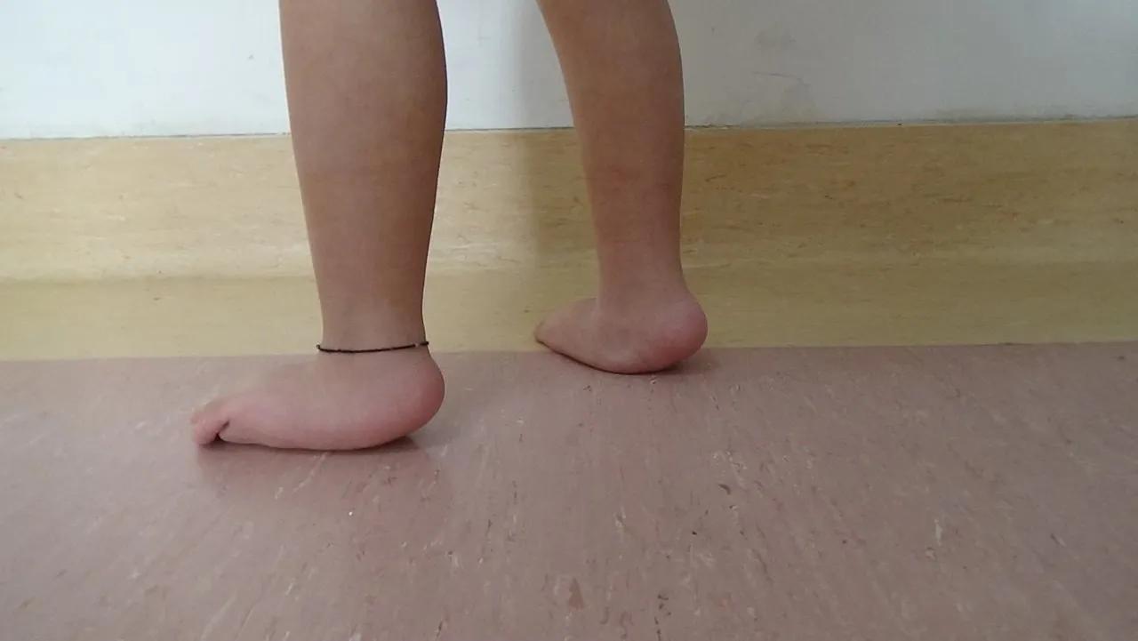 如何判断孩子足部有问题,儿童青少年的足部问题