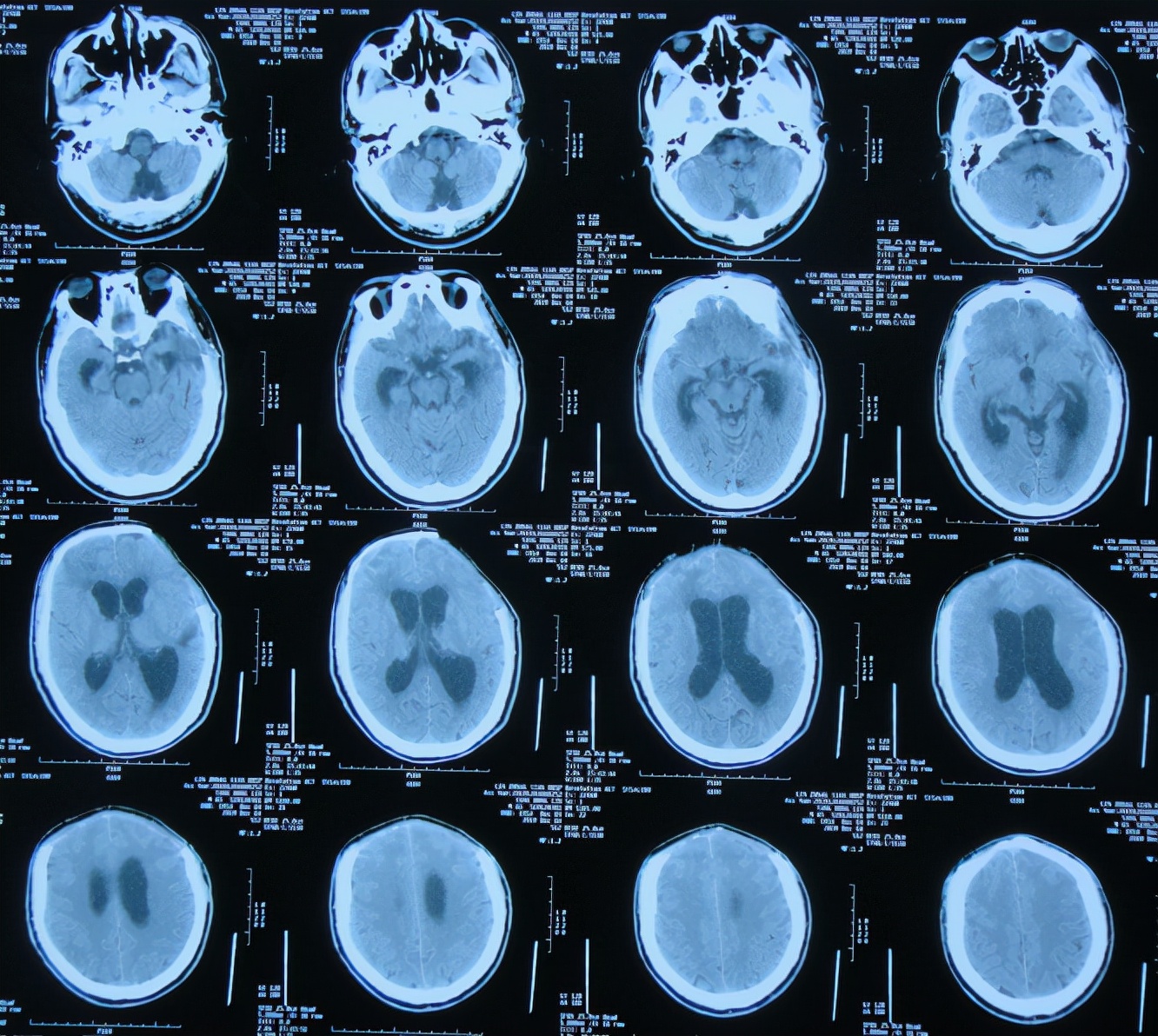 脑外伤后硬膜下积液颅骨修补,颅骨修复手术失败导致脑积水