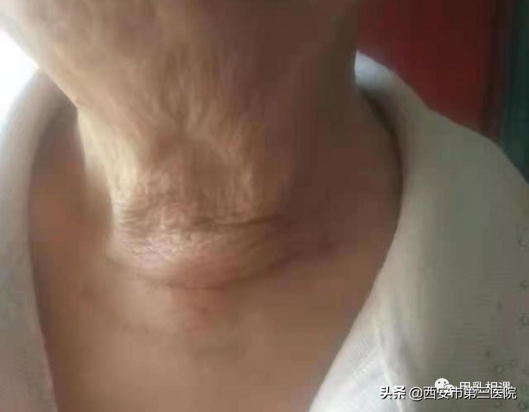 做甲状腺手术后瘢痕怎么描述,疤痕体质甲状腺手术后疤痕怎么办