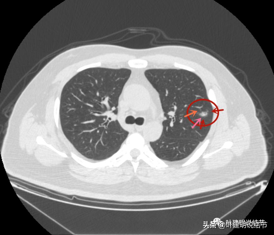 如何判断肺磨玻璃结节是高危结节,肺上有混合磨玻璃结节要注意什么
