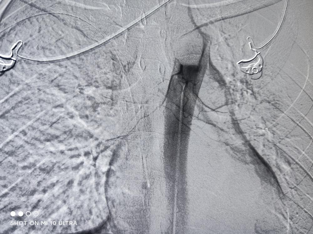 肺部肿瘤长在憩室里面,肺部5厘米的肿瘤要长多久