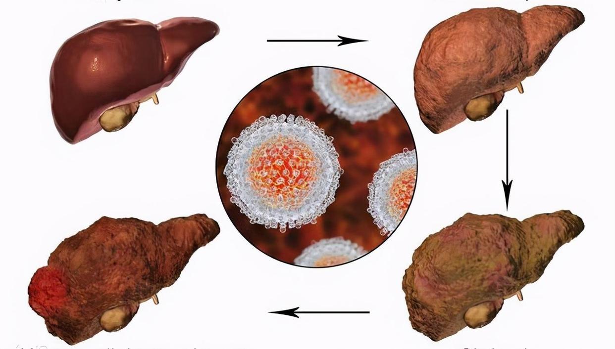 49岁女子查出肝癌后崩溃,23岁姑娘经常腹泻查出癌症