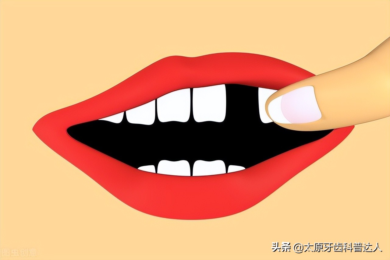 缺牙怎么办选择哪种镶牙方式,牙缺失哪种镶牙方式最好