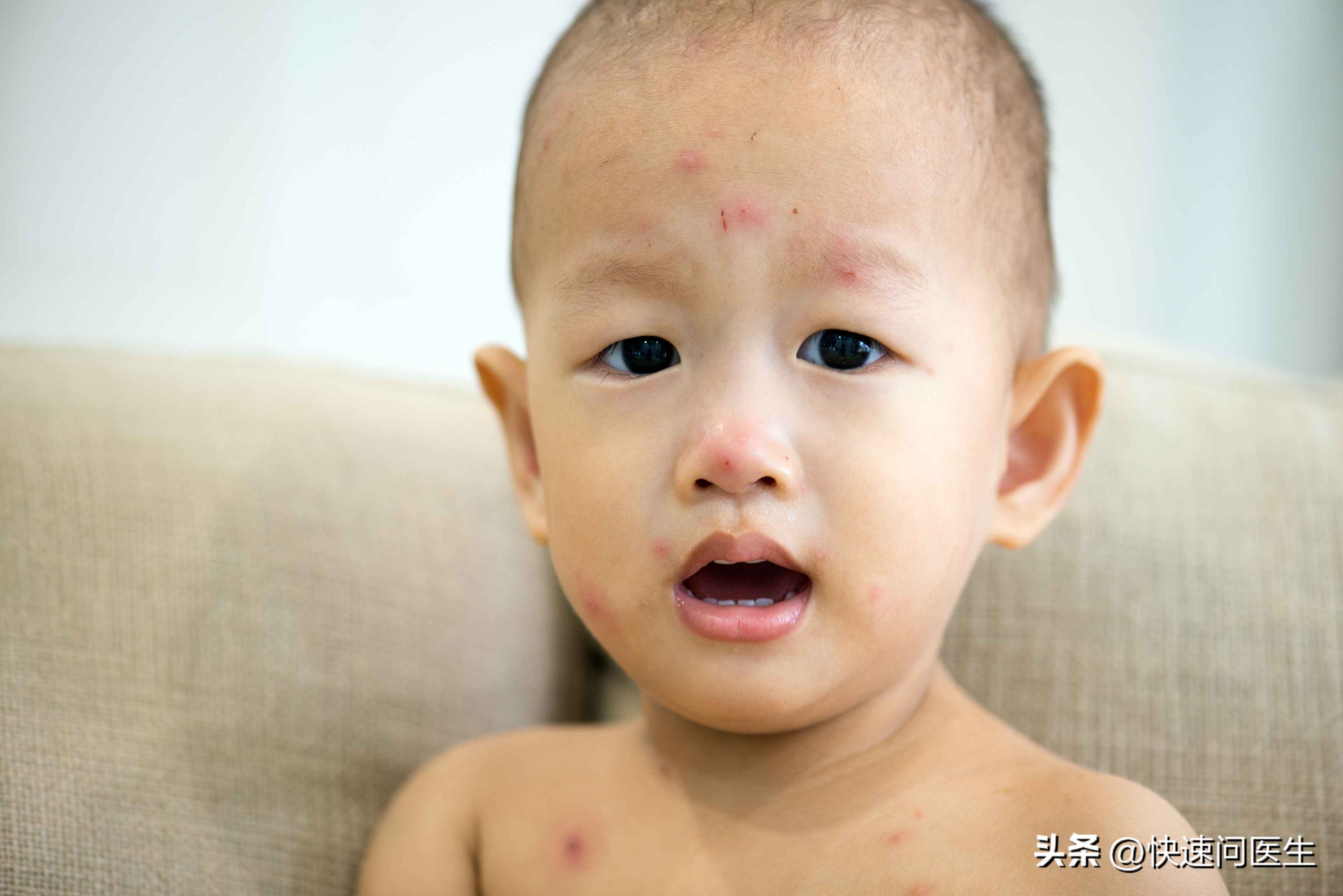 小孩出水痘发烧能喝板蓝根颗粒吗,孩子出水痘发烧能吃布洛芬吗