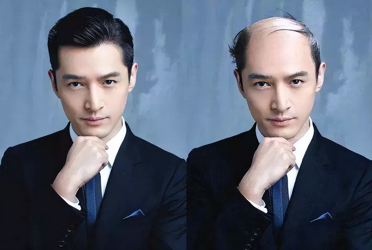 男子不用洗发水秃顶变黑发,男子半年不用洗发水秃变满头黑发