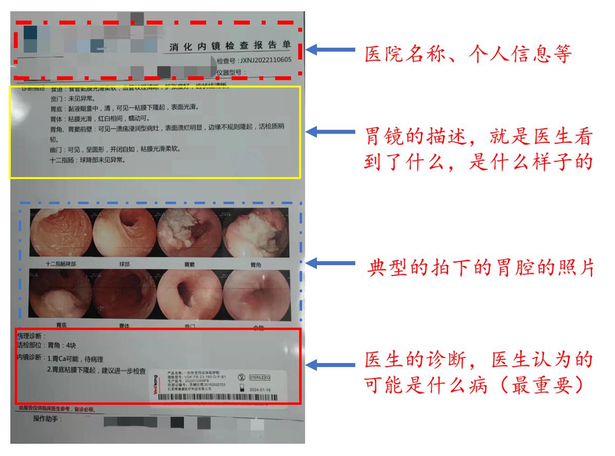初学者怎样学习胃镜的操作手法,胃镜怎么做的过程图片解说