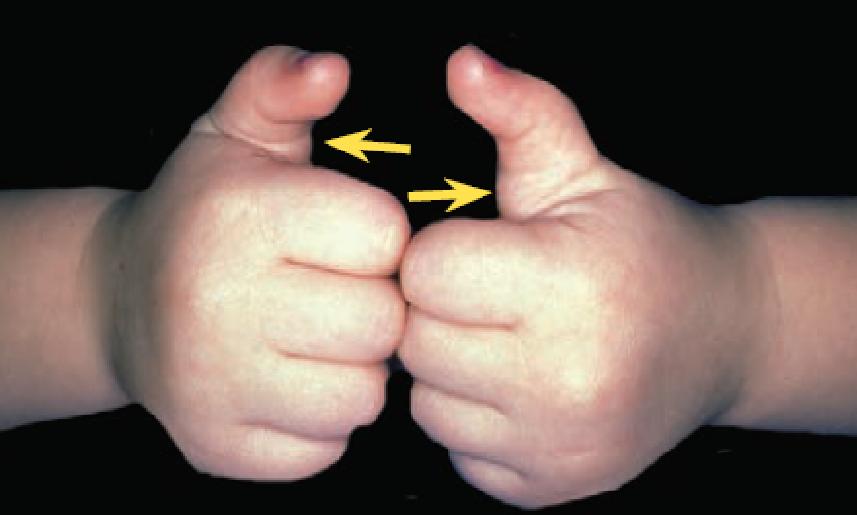 儿童手指伸不直需要矫正器吗,腱鞘炎手指伸不直怎么办