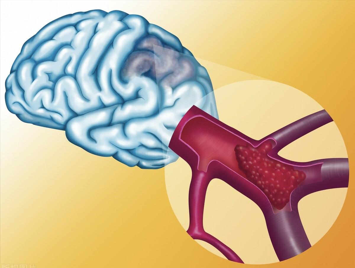 抗动脉粥样硬化最新药物,抗氧化预防动脉粥样硬化的药物是