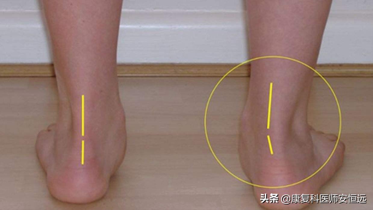 脚底板爱发烫是什么原因,脚底板生茧很疼怎么回事