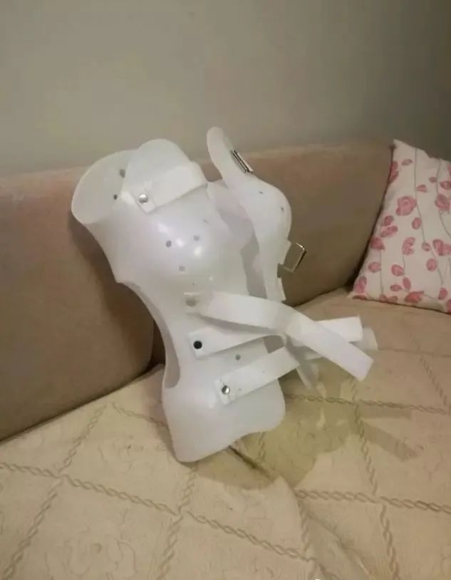 脊柱侧弯矫正支具不调整会怎样,简单辨别脊柱侧弯避免孩子走弯路