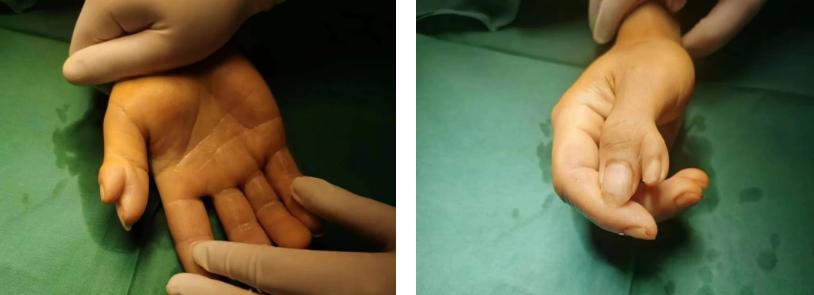 真人蟹钳型六指手术全过程,六指蟹钳切除手术哪家医院靠谱