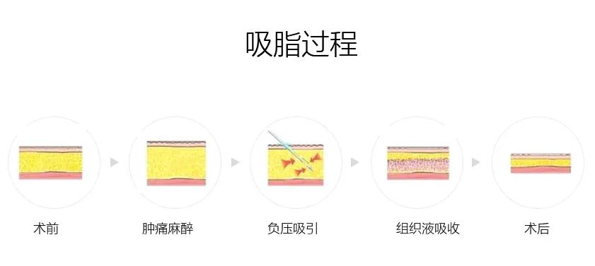 上海九院吸脂收费标准,九院韦敏面部吸脂