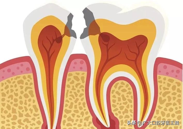 小心蛀牙,牙齿邻面龋坏轻微牙医说不用处理