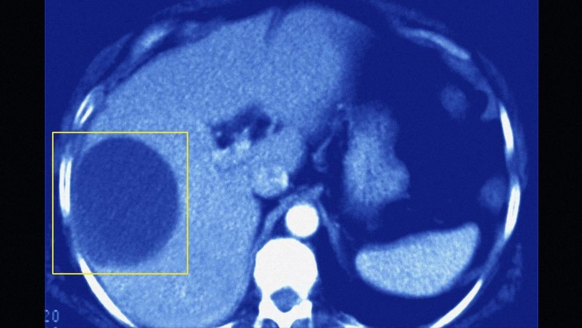 体检发现肝脏有囊肿怎么办,肝上有囊肿要看肿瘤科吗