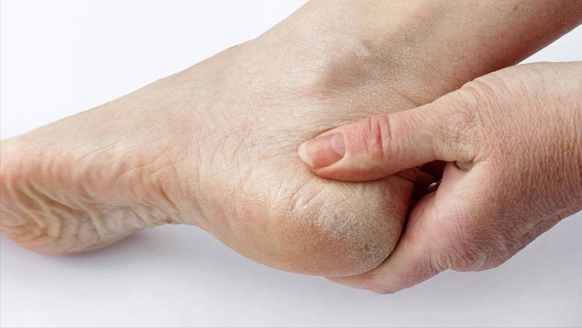 脚后跟起皮粗糙干裂涂维生素e,脚后跟干裂吃维生素b12行吗