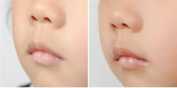 喝水很多嘴唇干裂起皮怎么回事,孩子嘴唇干裂出血怎么治疗