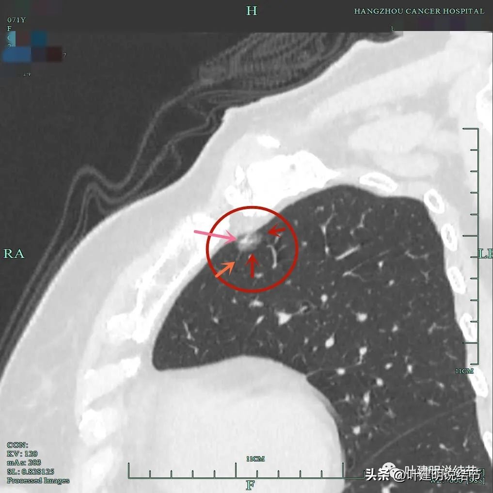 右下叶磨玻璃6mm结节基本上是癌,右下叶少许炎症上叶磨玻璃结节