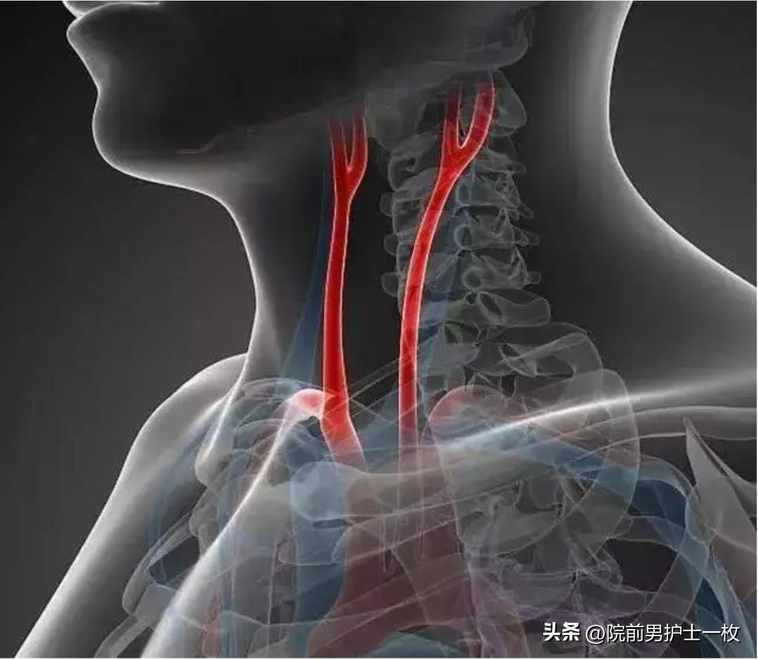 颈动脉斑块的相关知识,颈动脉斑块应该注意哪些事项