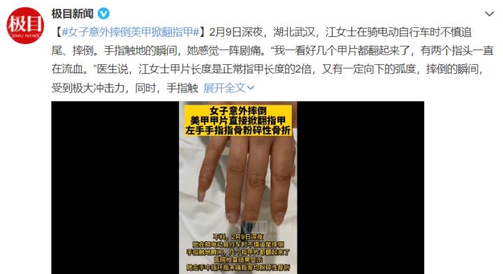 看着就疼!女子骑车意外摔倒,美甲掀翻指甲,两根指骨粉碎性骨折