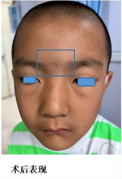 海绵状血管瘤手术头痛怎么回事,海绵状血管瘤3d手术