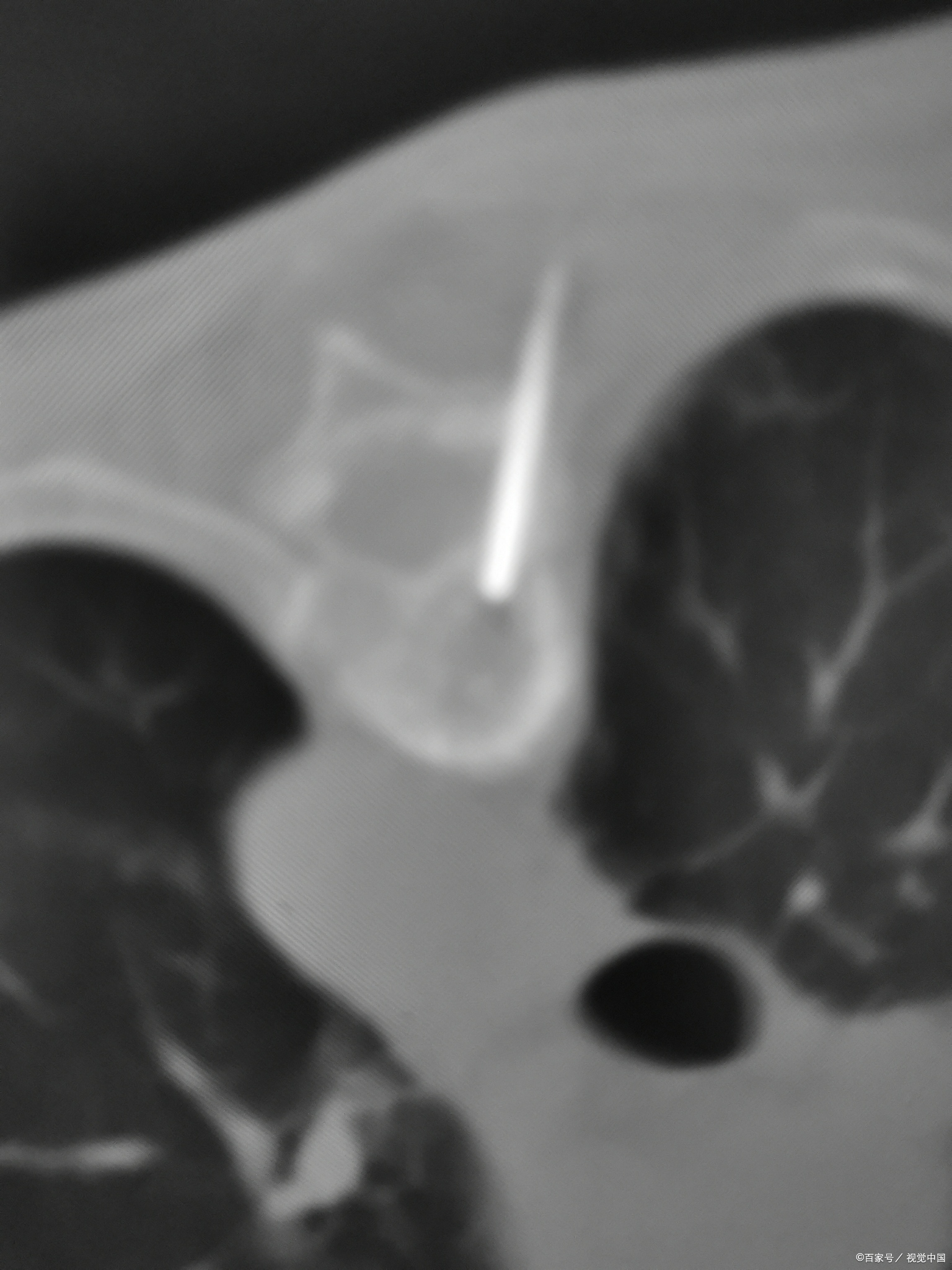 腰突压迫硬膜囊会越来越严重吗,腰突压迫神经有什么中药处方