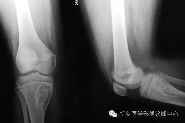 长骨膨胀性病变,长骨偏心性膨胀性病变