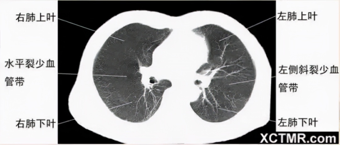 胸腹部盆腔ct主要检查什么,女性盆腔ct断层解剖结构图
