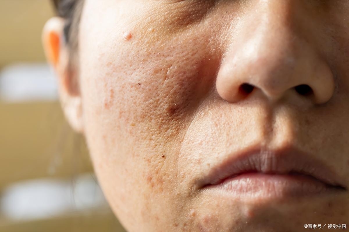 自己怎么改善毛孔粗大缩小毛孔,有痘痘毛孔粗大怎样缩小毛孔