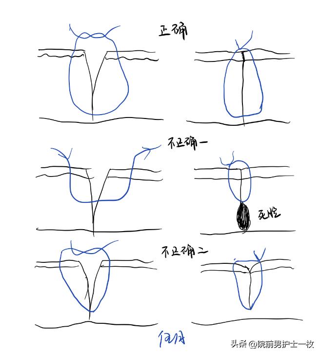 关于急诊清创缝合术必须掌握知识