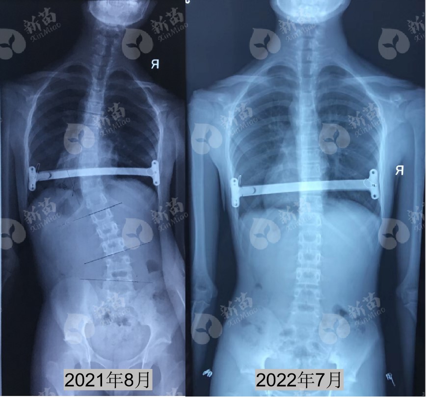 青少年脊柱侧弯如何自我矫正,青少年脊柱侧弯自我矫正
