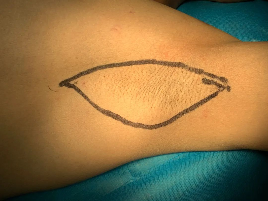 祛除狐臭腋臭,祛除腋臭