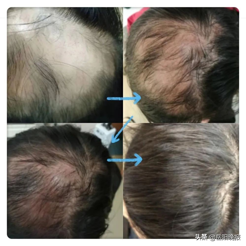 治疗鬼剃头吃茯苓,治疗鬼剃头的方法全部