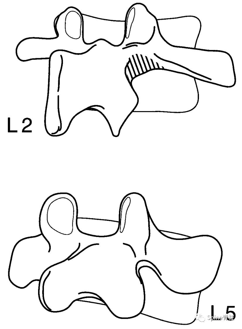 峡部裂和隐性峡部裂有区别吗,单纯峡部裂可以做峡部修复吗