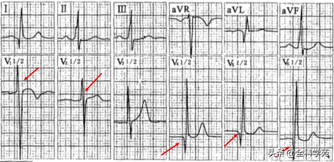 心电图笔记26：QRS波振幅变高，需要想到哪些
