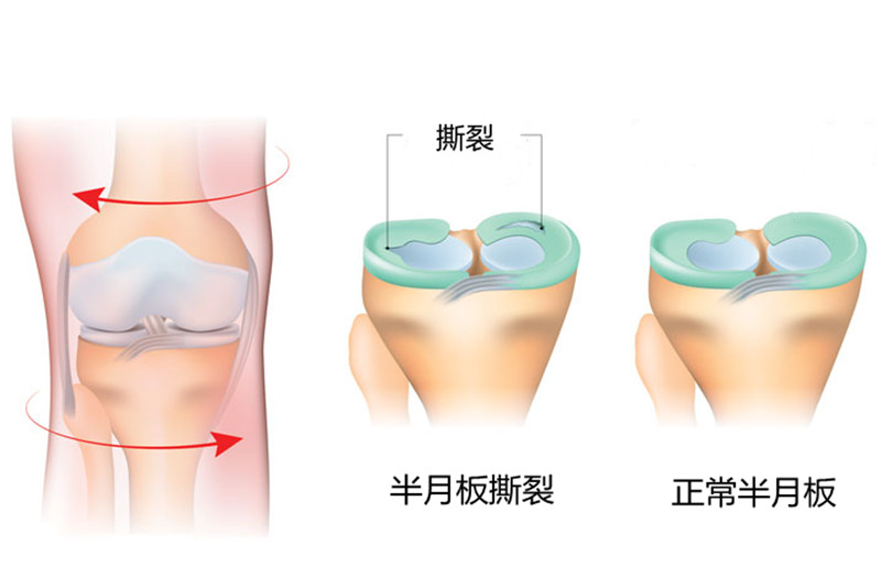 左膝盖不红不肿疼痛什么原因,膝盖内侧肿且疼痛是怎么回事