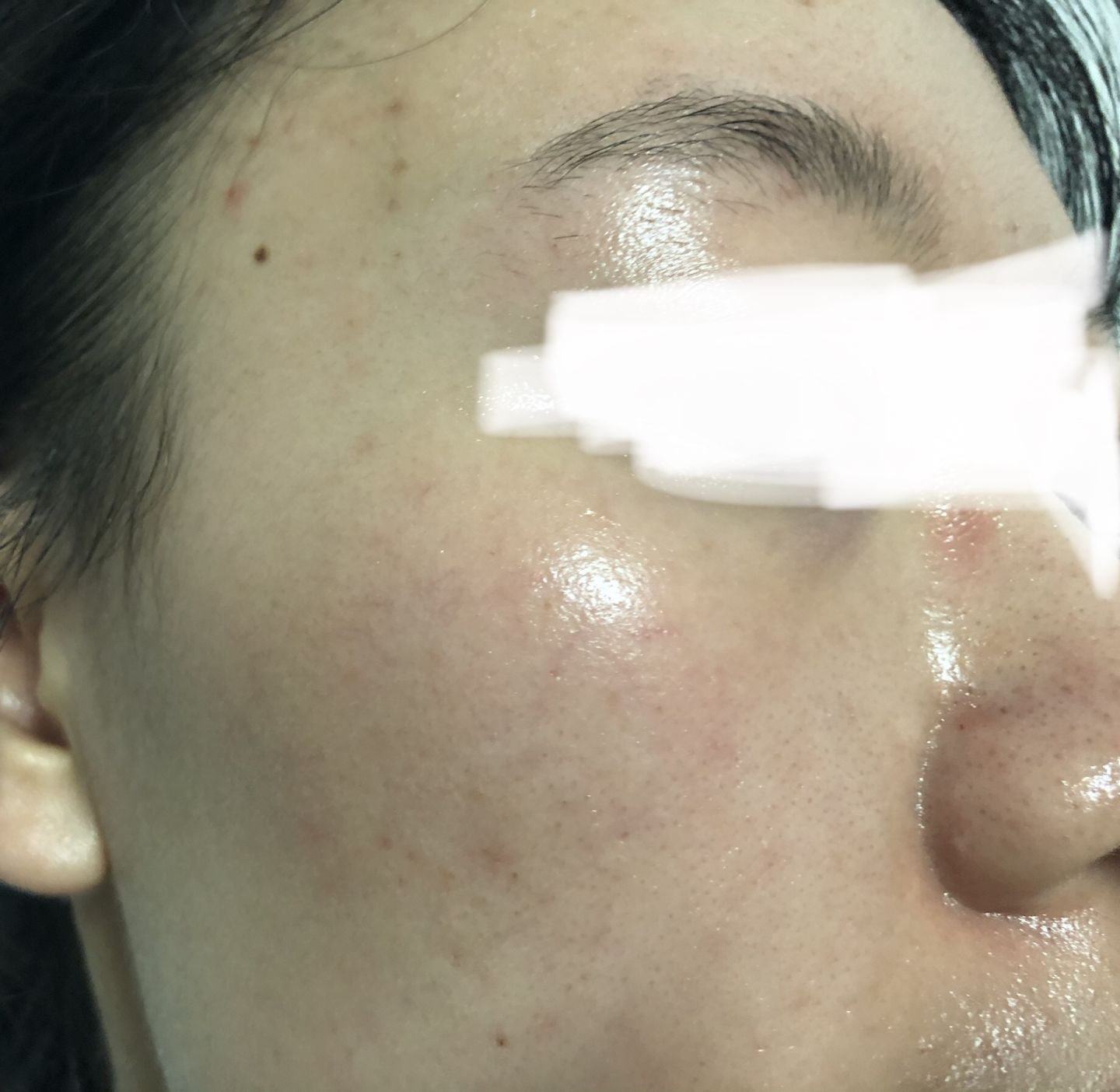 眉心鼻翼和下巴长粉刺为什么,鼻头上起粉刺什么原因引起的图片