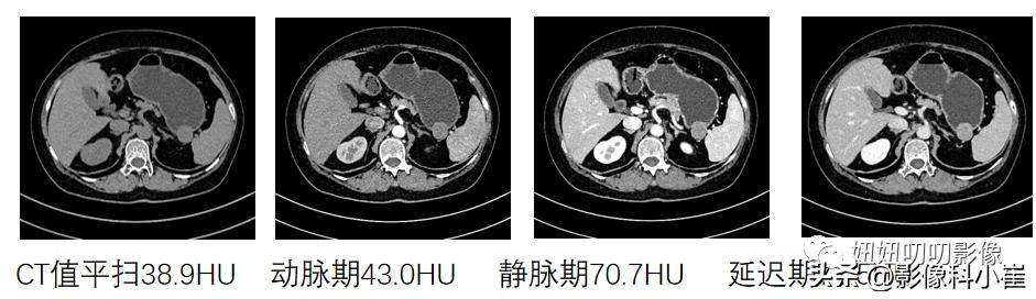 胃部肿瘤如果是恶性该怎么治疗,胃部肿瘤做什么能查出来