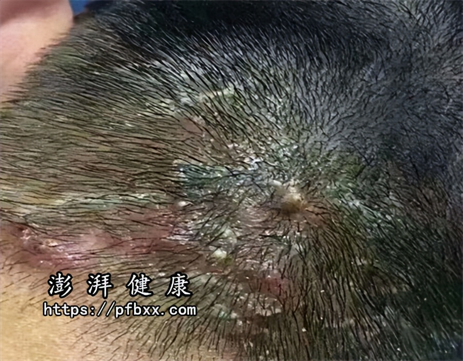 额头脖子背后面长痘痘有脓包很疼可以挤吗怎么办